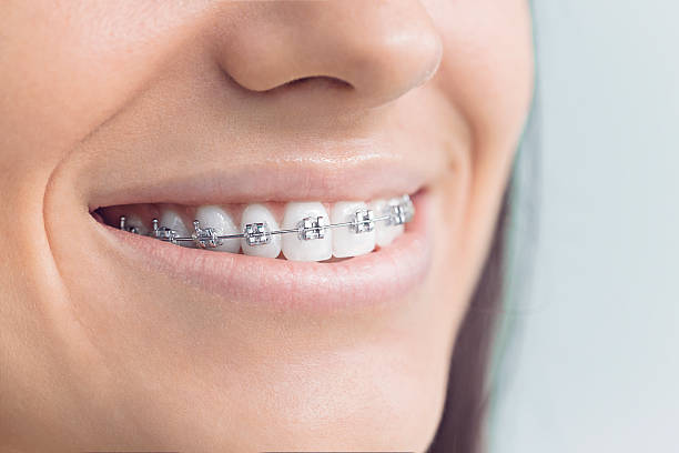 Best Teeth Whitening  in Rayne, LA